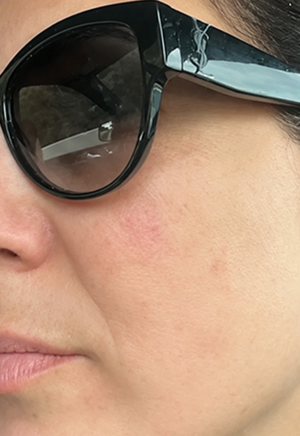 The same cheek with fewer dark spots and a more even tone after Sun Powder