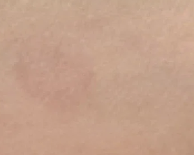 The same skin test spot with much less redness after Sun Powder