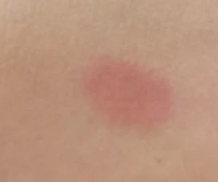 Skin test spot with visible redness before Sun Powder