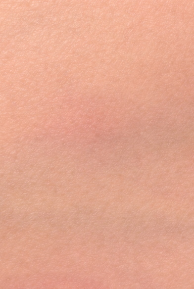 After: reduced redness, improved tone