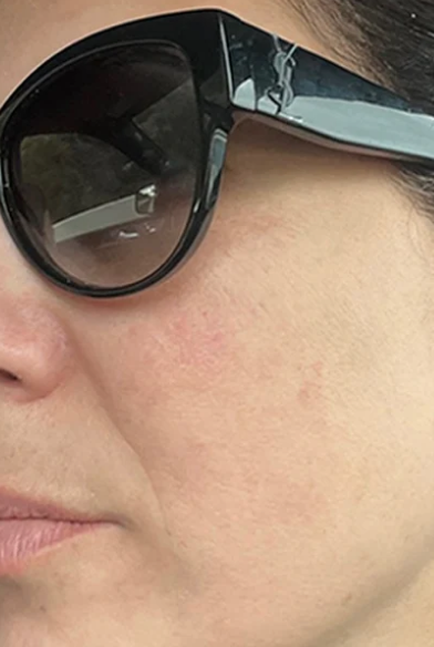 After: faded spots, even tone