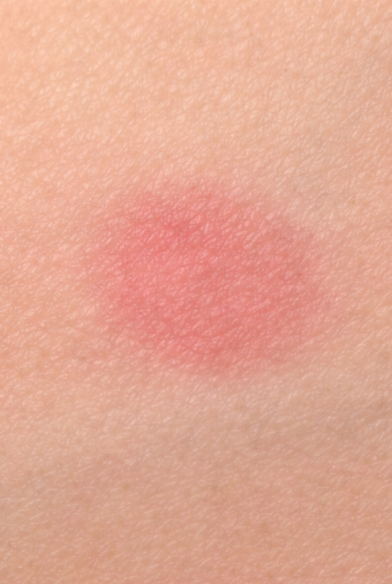 Before: redness and sun damage