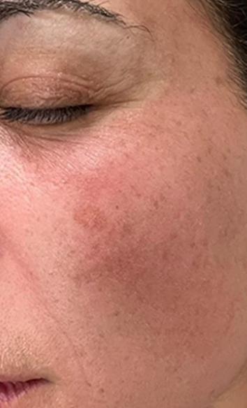 Before: dark spots and hyperpigmentation