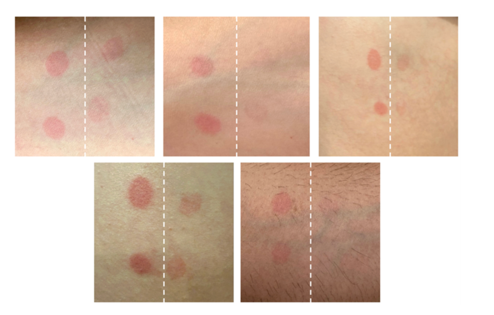 Five paired skin patches from the clinical trial: each pair shows clearly visible UV-induced redness on the untreated (left) side and reduced redness on the treated (right) side.