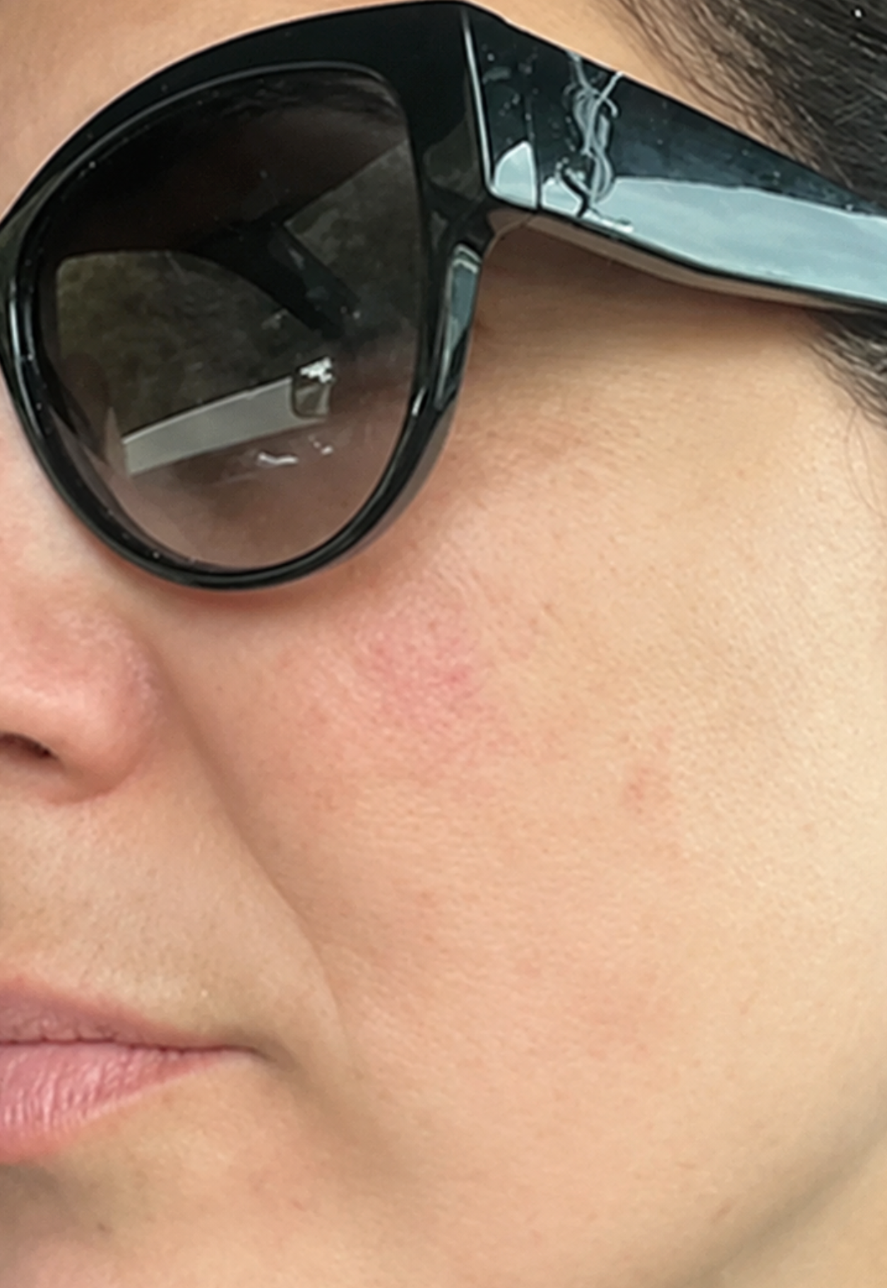 Dark spots after