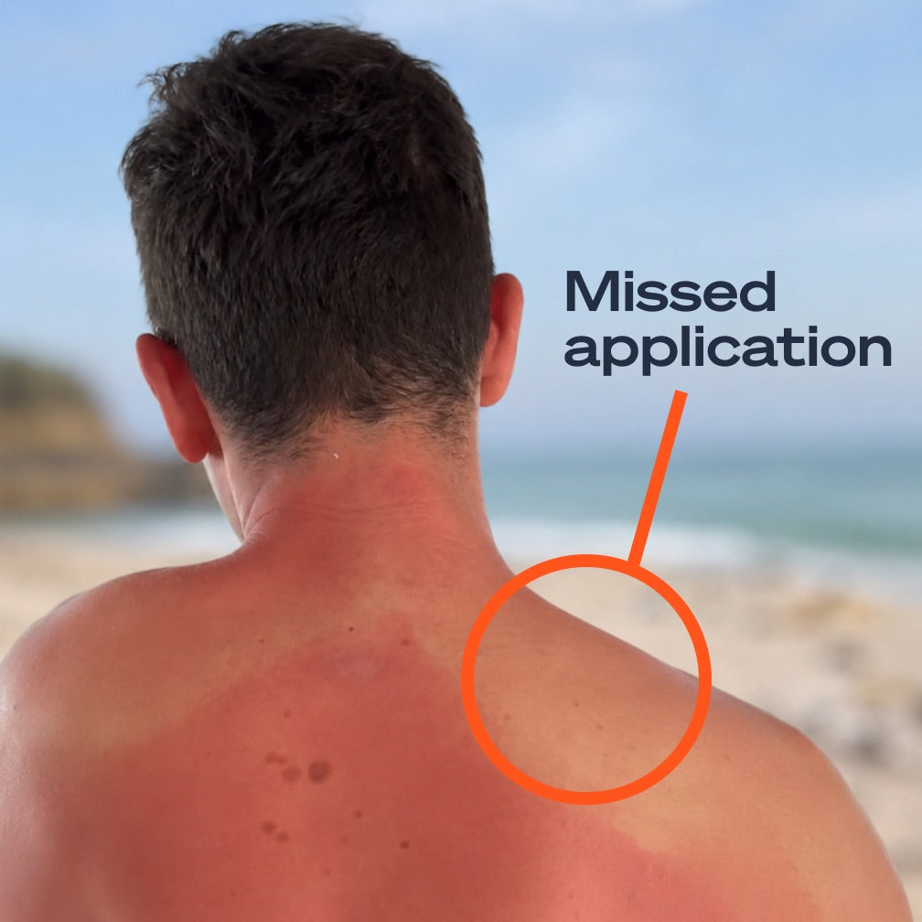 Sunburned shoulder showing missed sunscreen application