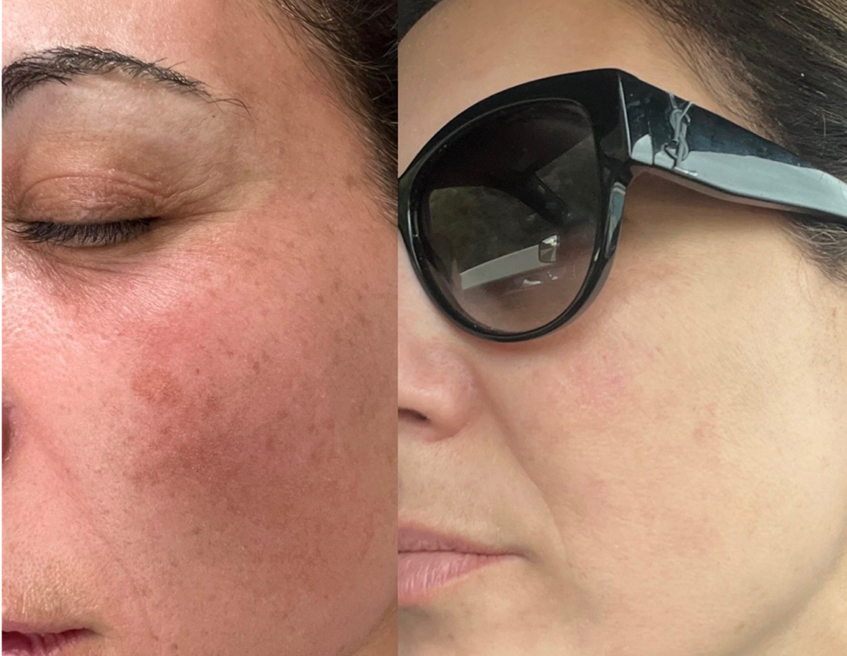 Customer before-and-after photos: day 0 on the left and day 90 on the right